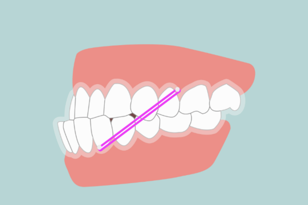 Type 3 Malocclusion