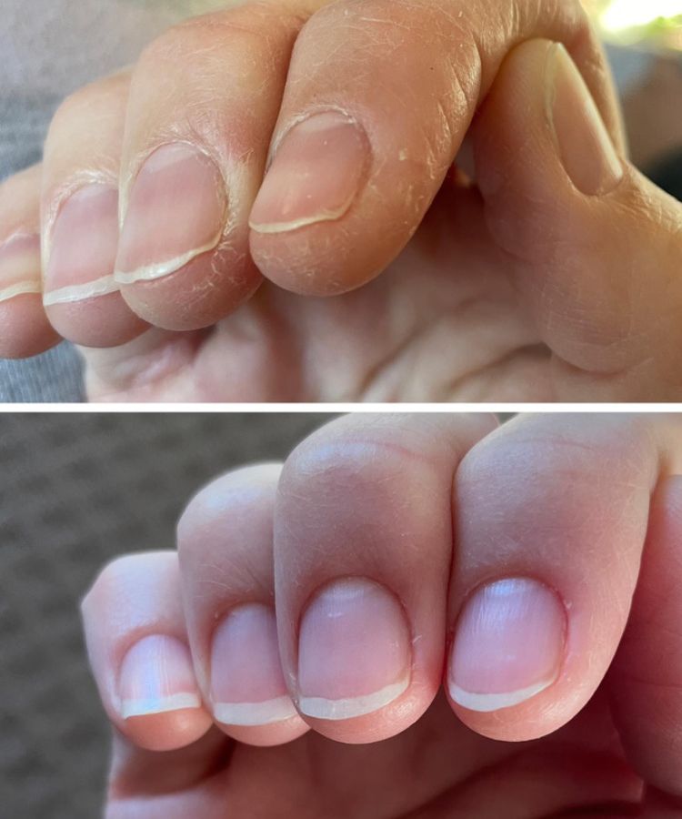 After 25 Years of Biting My Nails, I Think I've Finally Found a Solution —  See My Before & After Photos | Allure