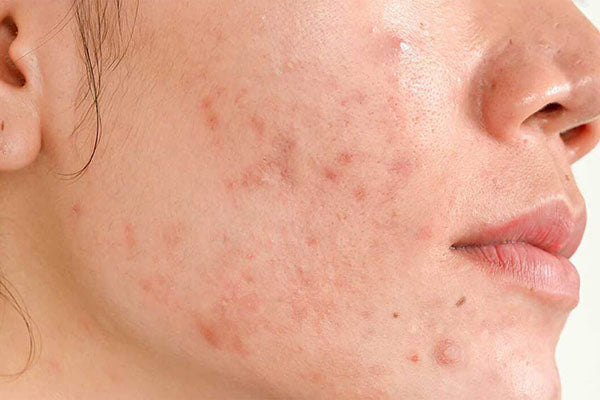 how-to-get-rid-of-hormonal-acne