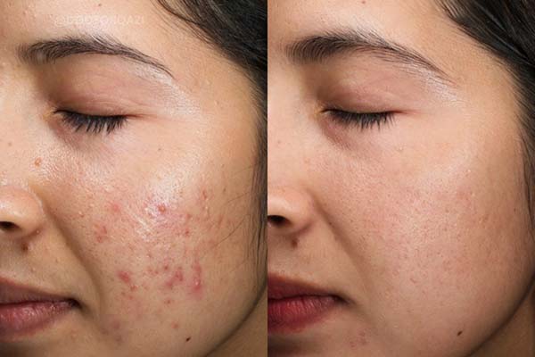 how-to-get-rid-of-hormonal-acne