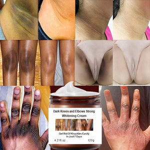 Niacinamide Dark Knees Knuckles Elbows Armpit Whitening Cream,Woman Private Parts Cream for Dark Skin - Vauguste Empire 
