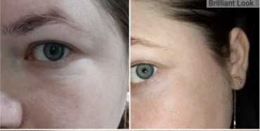 red light therapy before and after