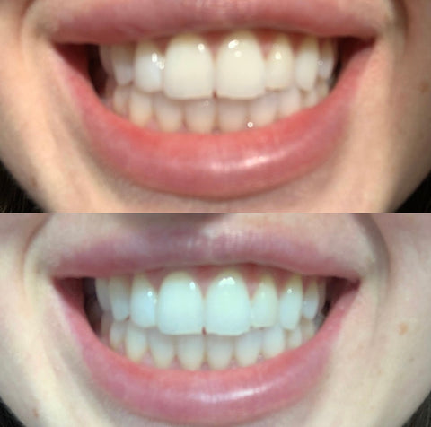 Real Smile Real Results. Teeth transformation. Whiter Smile. Brighter Smile