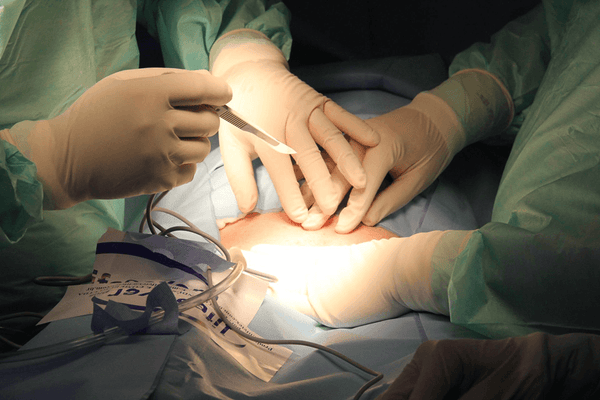 medical team performing a tummy tuck in an operating room