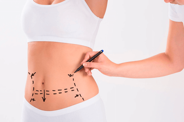 doctor drawing lines on a woman’s abdomen before her plastic surgery