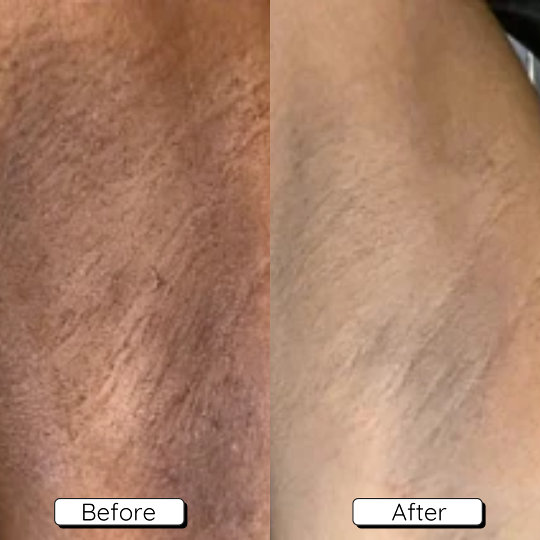 Before and after comparison of improved skin texture.