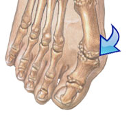 bunions-helped-wide-toe-box-shoes-foot-health