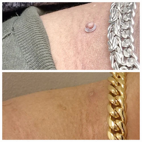 JEREMYTIS™Skin Tag Removal Kit