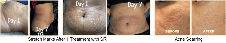 Stretch Marks After 1 Treatment with SR | Acne Scarring