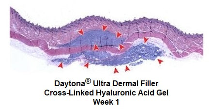 Daytona Ultra Dermal Filler Cross-Linked Hyaluronic Acid Gel Week 1