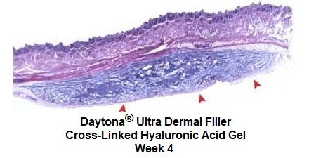 Daytona Ultra Dermal Filler Cross-Linked Hyaluronic Acid Gel Week 4