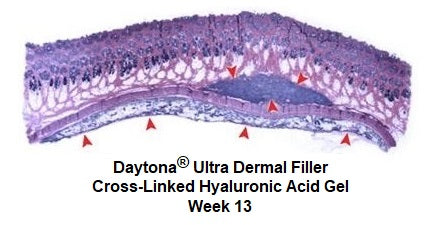 Daytona Ultra Dermal Filler Cross-Linked Hyaluronic Acid Gel Week 13