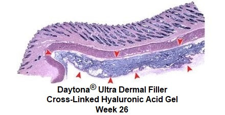 Daytona Ultra Dermal Filler Cross-Linked Hyaluronic Acid Gel Week 26