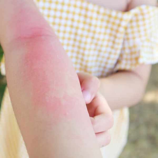 Allergic reaction to skin