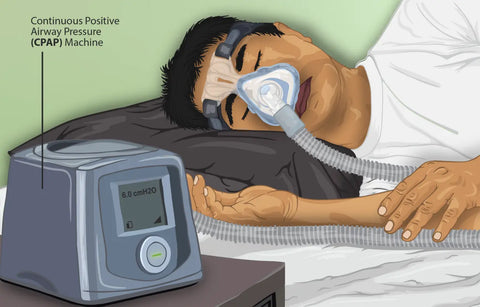 CPAP - Continuous Positive Airway Pressure