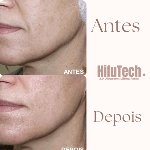 Antes e depois: Obtenha uma pele mais firme e tonificada com o Mini Hifu Tech 2.0 - recupere a elasticidade e o brilho