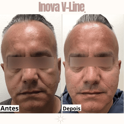 Antes e Depois: Inova V-Line - Redefinindo Contornos Faciais Masculinos também