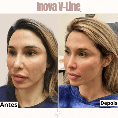 "Veja a Transformação: Inova V-Line - Lifting e Emagrecimento Facial 
