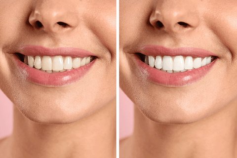 teeth-whitening-methods_whitening-strips