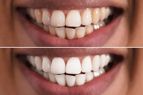 teeth-whitening-methods_whitening-toothpaste