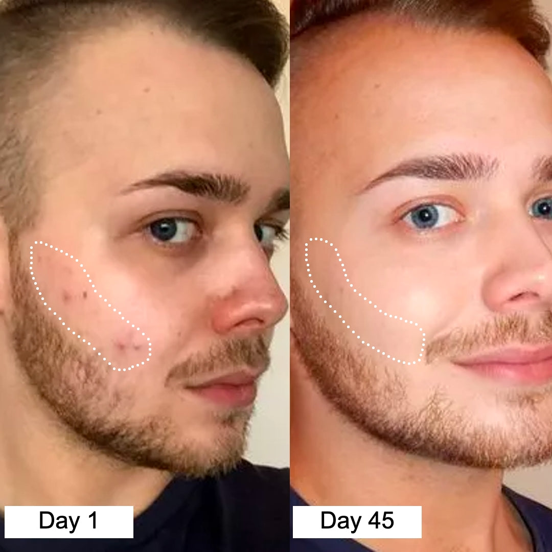 before after 1 acne 1-1(2) 99%.jpg__PID:d8729758-583d-4cc4-8934-14abc027e157