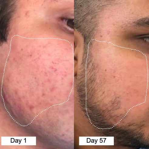 before after acne 1-1 4(2) 99%.jpg__PID:e920068d-dbd3-4221-823d-3ccc8afe2ae0