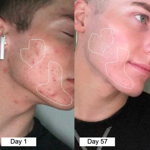 sdbefore after acne 1-1 3(2) webiste.jpg__PID:a185906c-f73b-4747-a0ab-50a1c666c713