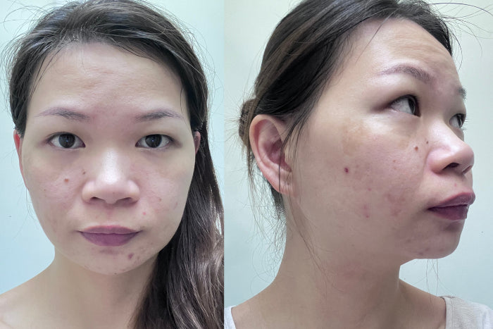 Joreen’s skin ageing and pigmentation concerns