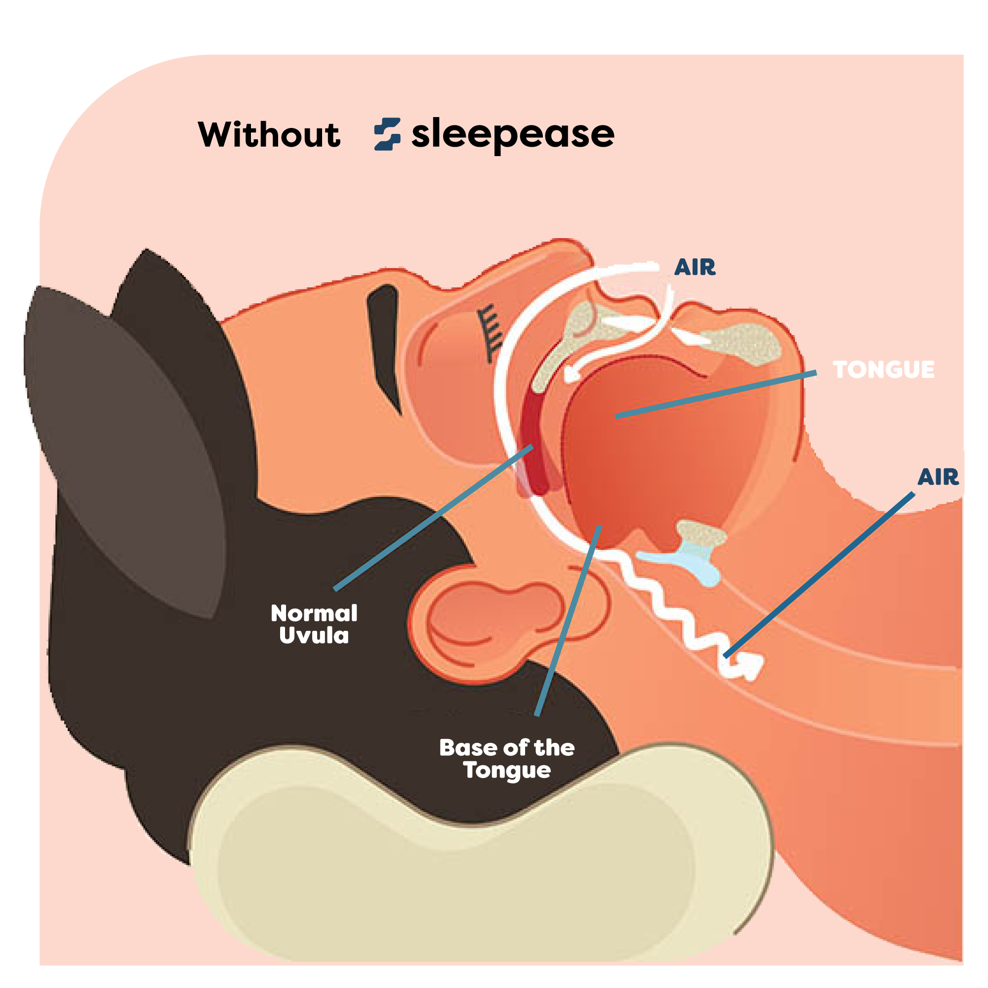 Diagram showing airflow obstruction in the throat during sleep without a sleepeace device.