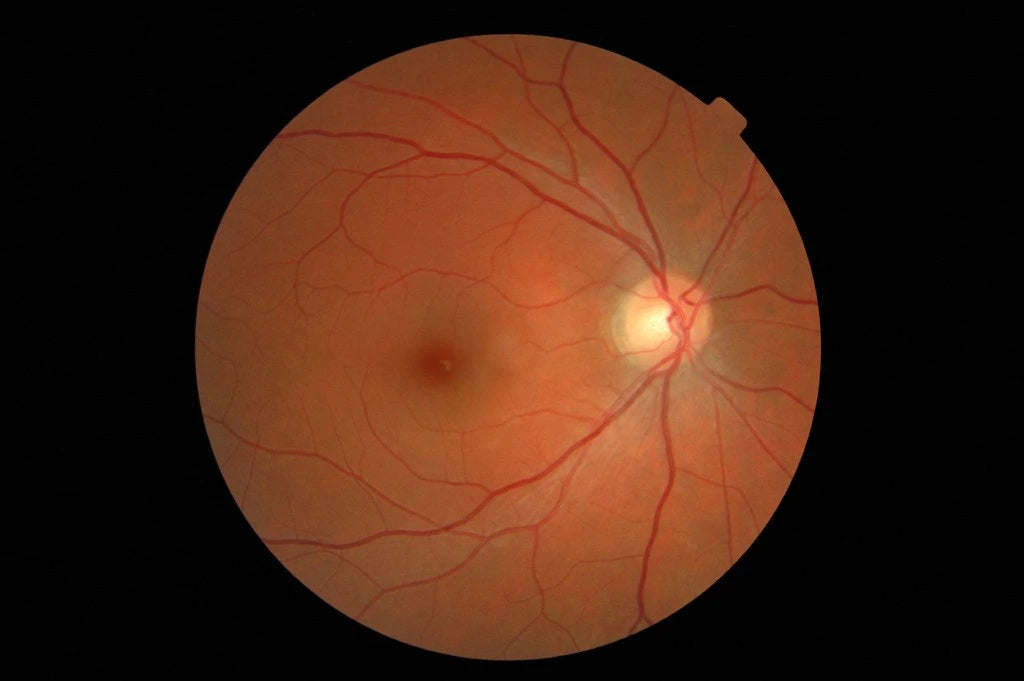 RETINAL.webp__PID:5bc5f1ad-f69b-4f46-9717-56d3e7ce779f