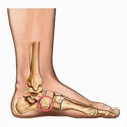 Accessory Navicular Syndrome