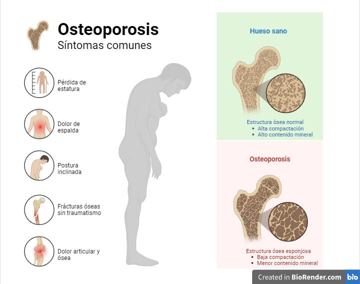 Síntomas Osteoporosis