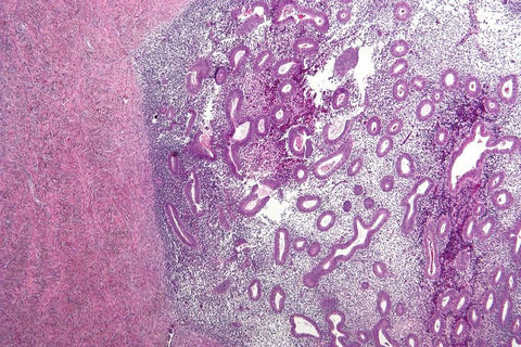 An image showing Endometriosis of an ovary