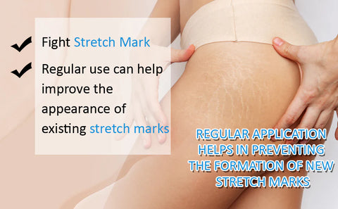 stretch marks Removal Cream