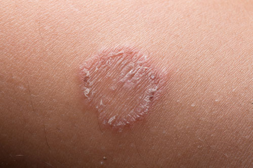 a close up of a ringworm on human skin