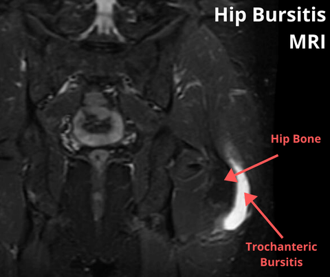 hip bursitis MRI