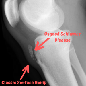 osgood schlatter disease xray