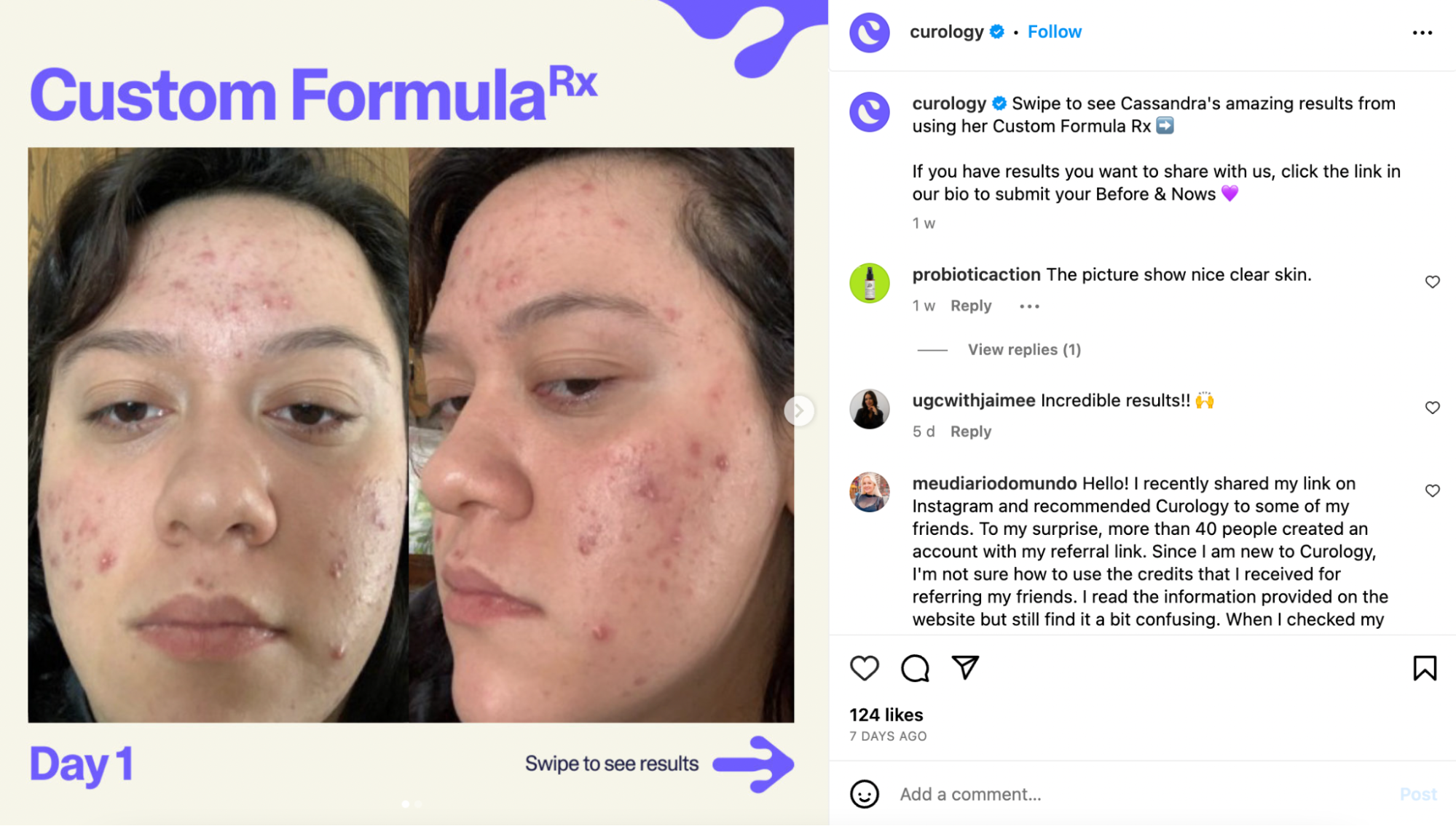 Before and after photos of a woman using Curology’s skin care products to help with acne.