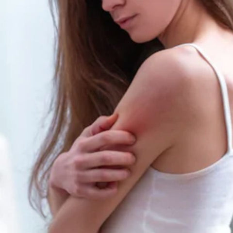 Image: Girl wearing a white tank top scratching her sore red arm