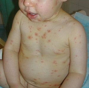 treating chicken pox