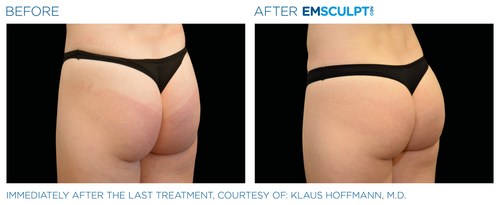 Emsculpt_Neo_PIC_Ba-card-female-buttock-045_ENUS100.png__PID:fe46871d-4dd0-4db2-91b9-78e658a3aa19