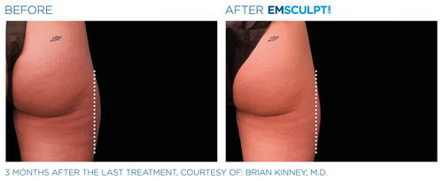 Emsculpt_neo_PIC_Ba-card-female-outer_thighs-093_ENUS100.png__PID:47fe4687-1d4d-40dd-b251-b978e658a3aa