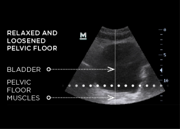 Relaxed-and-Loosened-Pelvic-Floor.png__PID:71095f34-3ab2-4505-9bf2-a98de96632e1