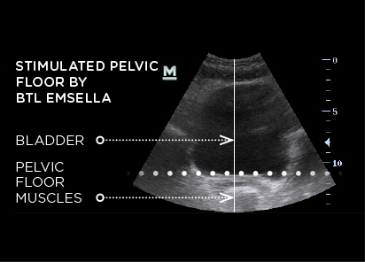 Stimulated-Pelvic-Floor-by-BTL-Emsella.png__PID:d571095f-343a-42a5-851b-f2a98de96632