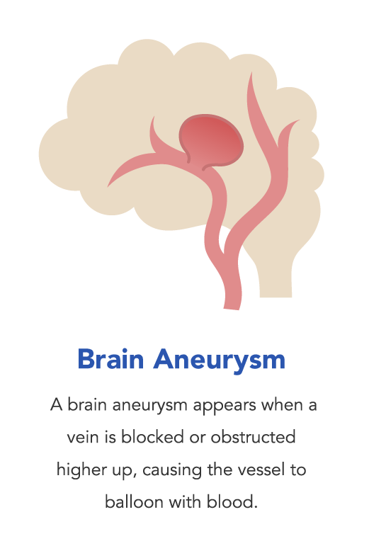 Brain Aneurysm, What Is a Brain Aneurysm