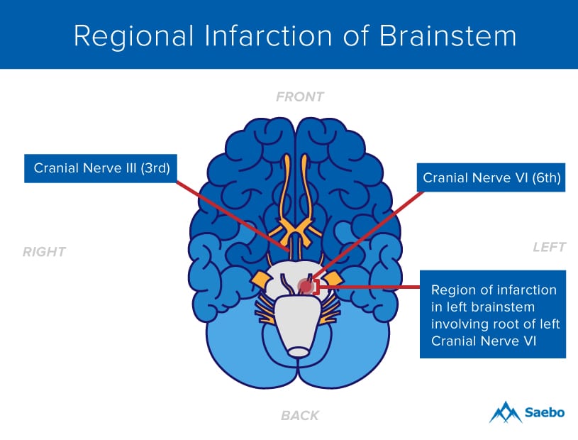 Regional-Infarction-of-Brainstem