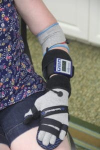SaeboStim Micro electrical stimulation machine paired with SaeboStretch resting hand splint on a person's arm