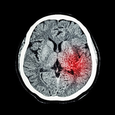 CT scan of brain show Ischemic Stroke or Hemorrhagic Stroke ** Note: Soft Focus at 100%, best at smaller sizes