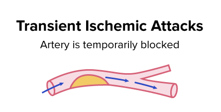 Transient Ischemic Attacks, Transient Ischemic Attack, Trans Ischemic Attack, Transient Ischemic Attack Definition, Transient Ischemic Attack Mini-stroke, Tia, Health Tia