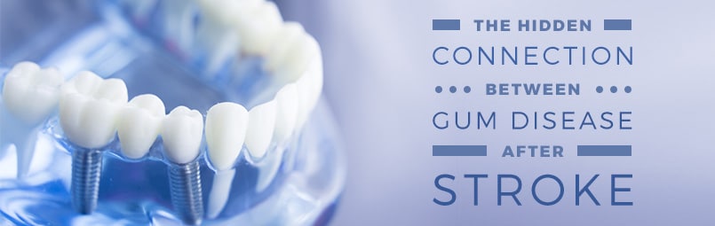 The Hidden Connection Between Gum Disease and Stroke